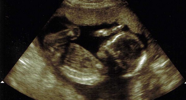 Abortusz előtt kötelező az ultrahang